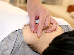 首に鍼をしている施術写真